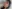Nasal Tip Plasty with Autologous Cartilage — Zena Plastic Surgery