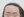 Forehead reduction (hairline lowering surgery) — before (8days) · Goyu Plastic Surgery Clinic