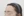Forehead reduction (hairline lowering surgery) — after (8days) · Goyu Plastic Surgery Clinic