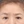 上眼瞼のたるみ取り（上眼瞼リフト・眉下切開） — 術前 (14日) · エイビー美容外科クリニック