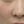 Laser Genesis (Cutera; long-pulsed 1064 nm Nd:YAG non-ablative rejuvenation) — before (28days) · J.Fill Clinic - Gangnam Branch