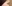 裏ハムラ法（経結膜的眼窩脂肪移動術） — ファクト美容外科クリニック