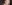 incisional double eyelid surgery — Baba Plastic Surgery Clinic