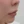 โบท็อกซ์ร่นร่องริมฝีปาก (Lip Flip ทำให้ร่องใต้จมูกดูสั้นลง) — ก่อนทำ (7วัน) · คลินิก Younme
