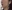 Double chin liposuction (submental liposuction) — Seoul During Clinic