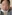 Double chin liposuction (submental liposuction) — Saegim Plastic Surgery Clinic