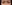 Lower Eyelid Fat Repositioning (transconjunctival) — Pleasure Plastic Surgery Clinic