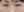 Eyelid filler (upper eyelid hollowing correction) — before · The Ollim Plastic Surgery Clinic