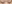 二重まぶた（自然癒着法） — イエロー美容外科クリニック