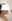 Platysma plication (corset platysmaplasty for double chin/jawline) — Shinsang Plastic Surgery Clinic