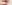 人中短縮（リップリフト） — プランナー美容外科クリニック