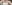 二の腕の脂肪吸引 — ニュースリムクリニック