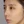 ฉีดลดขนาดจมูกแบบไม่ผ่าตัด (สลายไขมัน+สเตียรอยด์+โบท็อกซ์) — หลังทำ · คลินิก U