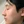 ฉีดลดขนาดจมูกแบบไม่ผ่าตัด (สลายไขมัน+สเตียรอยด์+โบท็อกซ์) — หลังทำ · คลินิก U