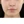 Ultraformer MPT (อัลตร้าฟอร์เมอร์ เอ็มพีที) — ก่อนทำ · คลินิกเบด