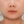 Rejuran S (รีจูรัน S กล่องน้ำเงิน — หลุมสิว/แผลเป็น) — ก่อนทำ · พิกเซลแล็บศัลยกรรมพลาสติก