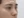 Nasal tip augmentation with implant — after (7days) · The Ollim Plastic Surgery Clinic