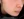 Volnewmer (โวลนิวเมอร์ ยกกระชับด้วย RF) — ก่อนทำ (21วัน) · คลินิกพาร์ควิว สาขาจัมซิล