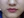 Botox for nasolabial folds — after (30days) · K-Tox Clinic - Bupyeong Branch