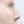 Nasal osteotomy (nasal bone narrowing) — before (7days) · Pop Plastic Surgery Clinic