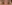incisional double eyelid surgery — Wivers Plastic Surgery Clinic
