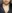 Corner lip lift (mouth corner lift) — Like Plastic Surgery Clinic
