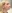 Full-face fat grafting (autologous fat transfer) — Anersty Plastic Surgery Clinic