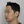 Density Lifting (RF skin tightening / lifting) — after · Ripain Clinic