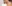 裏ハムラ法（経結膜的眼窩脂肪移動術） — ルアク美容外科クリニック
