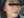 Chemical peel — after (7days) · Le Shine Clinic