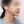 下巴異物取出（下巴假體移除） — 術前 (30天) · Returning醫美診所