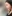 人中短縮（リップリフト） — プランナー美容外科クリニック