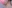 二重あごの脂肪吸引（顎下脂肪吸引） — マイン美容外科クリニック