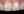 Composite resin filling — before · Yonsei Good Day Dental Clinic - Suseo Branch
