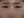 ฉีดไขมันตัวเองทั้งใบหน้า (ศัลยกรรมเติมไขมันใบหน้า) — หลังทำ (14วัน) · คลินิกศัลยกรรมพลัส