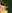 Lip lift (philtrum reduction) — Hyundai Aesthetics Plastic Surgery