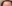 額縮小術（生え際下げ・ヘアライン下降術） — ザフィックス美容外科クリニック