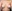 乳房挙上術（バストリフト）＋豊胸術 — ヒューマン美容外科