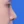 ผ่าตัดเอาสิ่งแปลกปลอมออกจากจมูก (เอาซิลิโคนจมูกออก) — หลังทำ (14วัน) · คลินิกโคบิจู