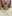 Lip filler (lip augmentation with HA) — Lollipop Plastic Surgery Clinic