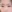 incisional double eyelid surgery — Brown Plastic Surgery