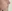 Nasal Tip Plasty with Autologous Cartilage — Litmus Plastic Surgery