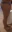 Thigh liposuction — Uri Plastic Surgery Clinic