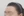 Forehead reduction (hairline lowering surgery) — after (9days) · Goyu Plastic Surgery Clinic