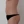 Back liposuction — before (13days) · Hourglass Clinic