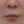 โบท็อกซ์ร่นร่องริมฝีปาก (Lip Flip ทำให้ร่องใต้จมูกดูสั้นลง) — ก่อนทำ (7วัน) · คลินิก Younme