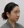 ฉีดสลายไขมันหน้า (เมโสแฟตแก้ม) — หลังทำ · ศูนย์ศัลยกรรม Zero - สาขาชินซา