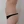 Back liposuction — before (14days) · Hourglass Clinic
