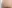額（おでこ）の脂肪注入 — プレジャー美容外科クリニック