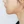 ศัลยกรรมลดขนาดคาง (กรอ/ตัดกระดูกคาง) — หลังทำ (14วัน) · คลินิกเอเคศัลยกรรมพลาสติก